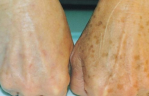 Pigmentové skvrny můžete odstranit snadno a rychle! Není nutné operace ani laser. Stačí olej, který je téměř zázrak